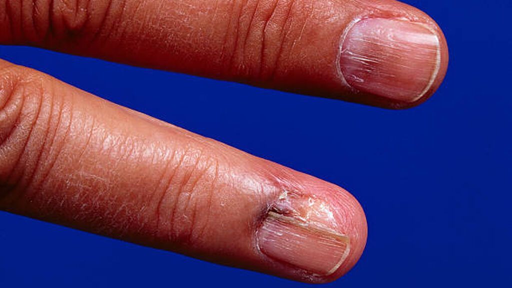 Manchas en las uñas cuándo son peligrosas Así puedes diferenciar el  melanoma de un hematoma u hongos  Vivir  COPE